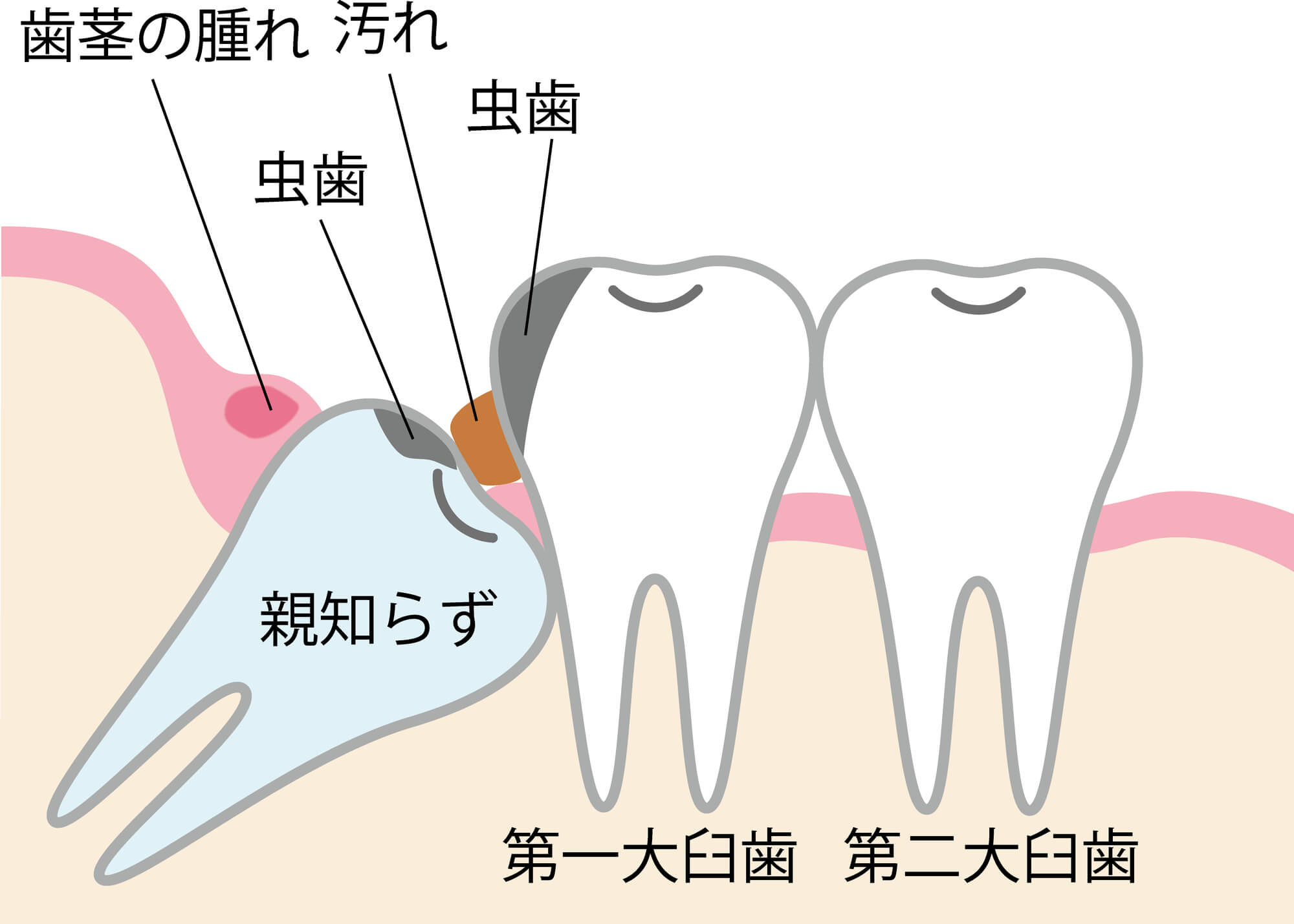 ジスキネジーや舞踏病の危険因子は何ですか?